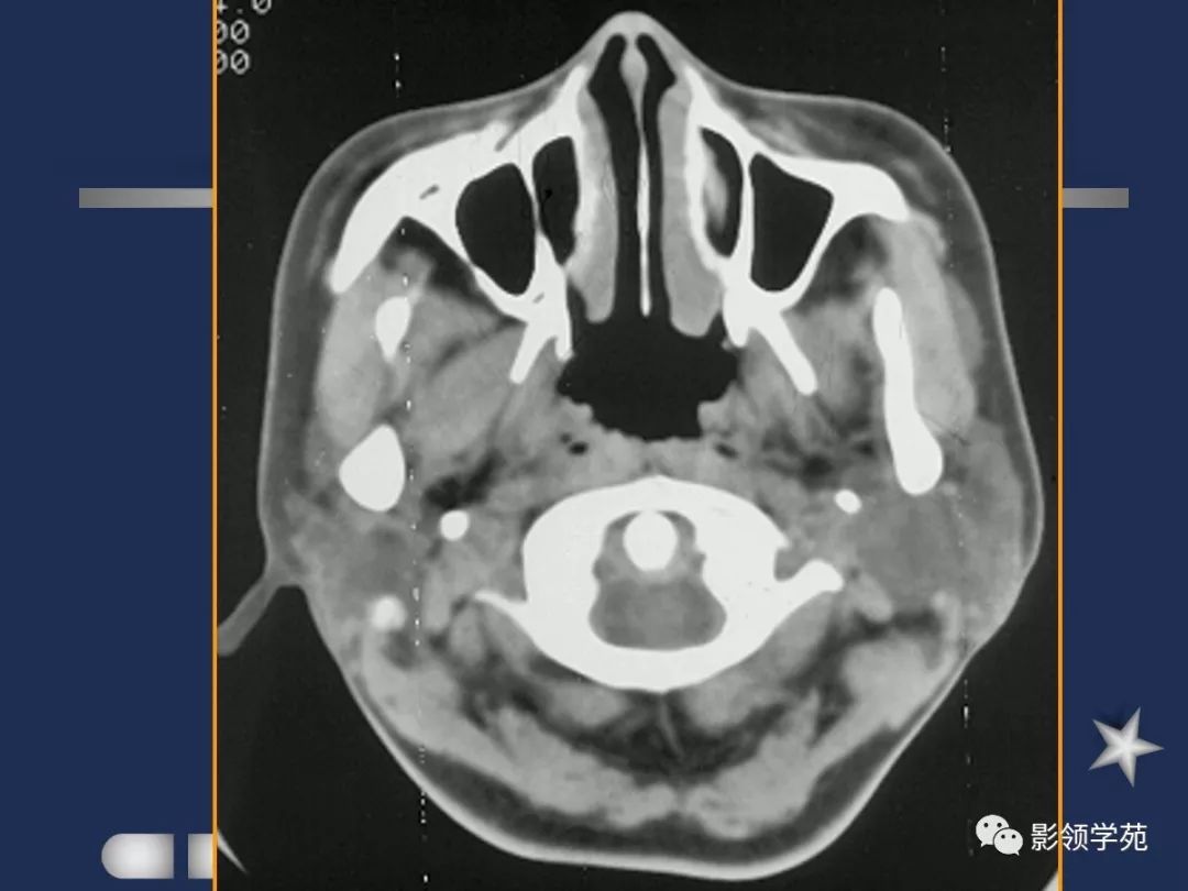 腮腺疾病影像学诊断,腮腺肿块影像诊断