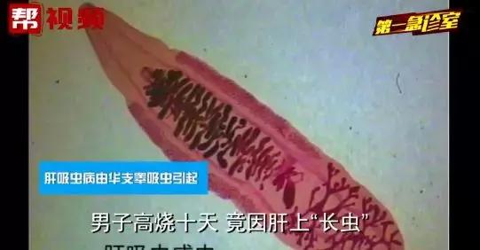 可怕男子高烧10天肝脏惊现寄生虫,男子高烧10天肝脏发现寄生虫