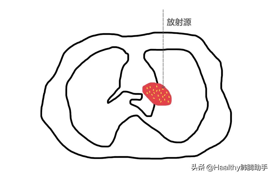 带着射线逛街,很拉风吧|肺腾讲堂:内放疗与外放疗的区别