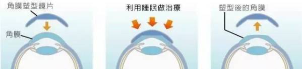 父母近视孩子就一定近视吗,父母近视孩子会怎么样