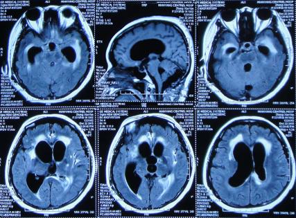 结核性脑积水,脑膜炎脑积水要治疗多久