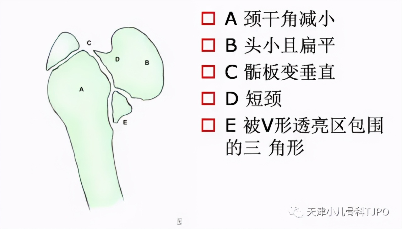 小儿先天性髋内翻名词解释,小孩走路颠足内翻