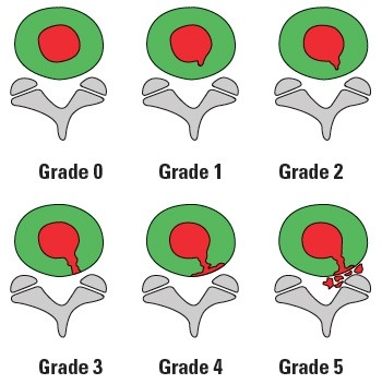 久治不愈腰痛,磁共振没有突出间盘后缘白点,要警惕这病③