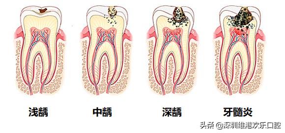 牙齿小洞你不瞅，变成大洞愁上愁