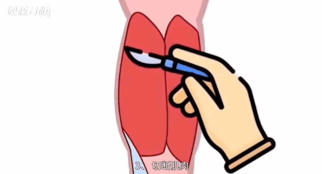 划开头皮、切断肌肉,为了美她们能做到什么程度?