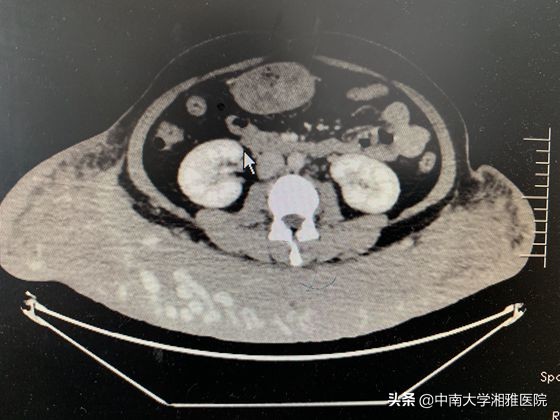女子手术切除巨大肿瘤后续,女子切除50多斤肿瘤