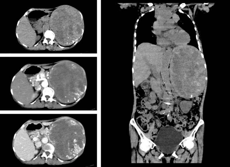 排球那么大的肿块！75岁阿婆腹部越长越大的原因找到了