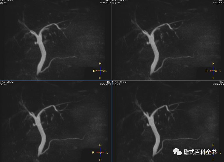 开展mrcp技术,mrcp检查操作流程