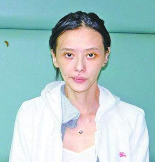 靠袒胸搏出位,3次吸毒被抓,如今患癌的她为保命切除5个器官