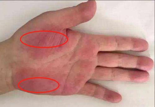 怀孕后发现胸口有一颗蜘蛛痣,孕妇怀孕皮肤有胎记