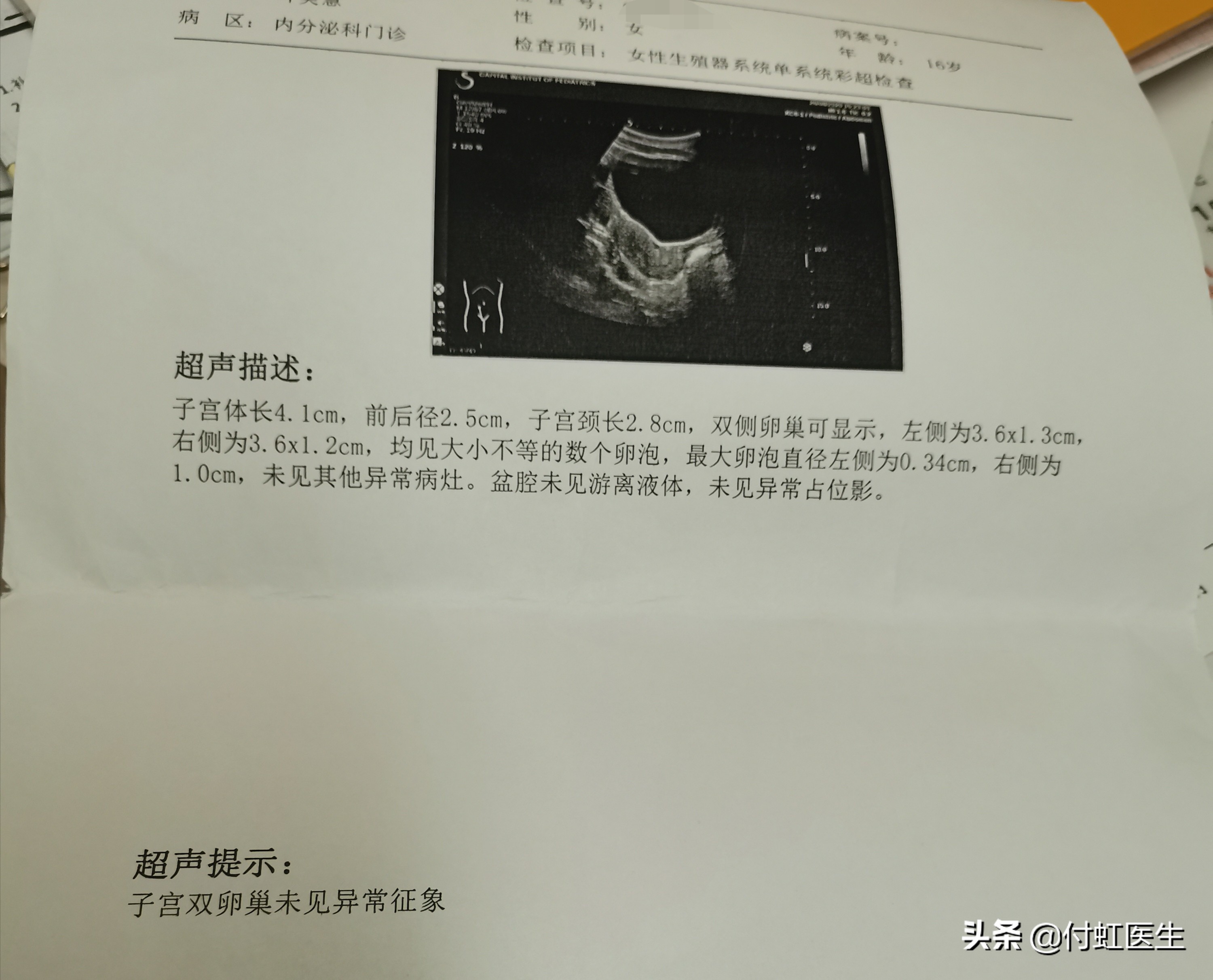 16岁月经紊乱、脱发、*疮痤**、面貌变丑，原来是这个病在作怪