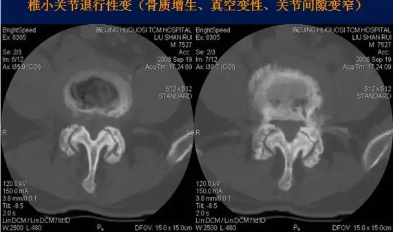 腰椎退行性变腰椎间盘轻度突出,椎间盘突出并膨出继发椎管狭窄