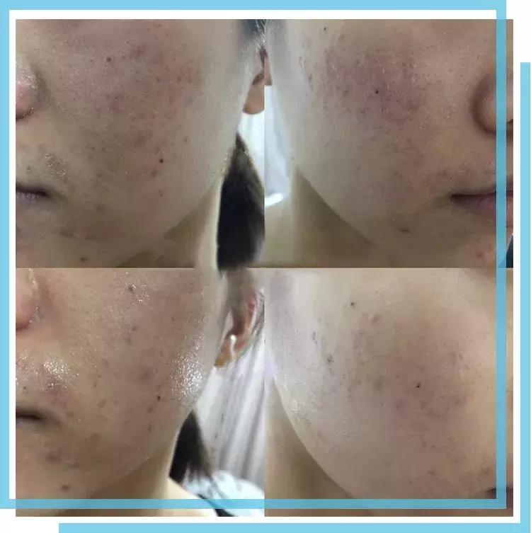 如何有效的祛痘印医美面膜,消炎祛痘的医美面膜