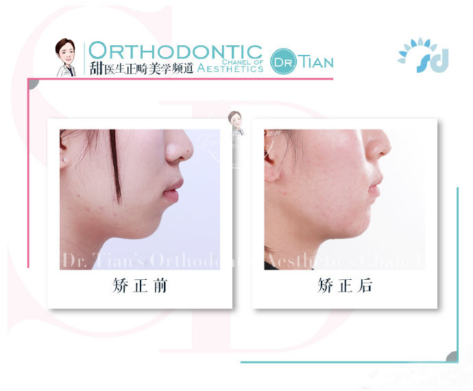 西安哪里有做牙齿矫正,在西安哪里可以做牙齿矫正