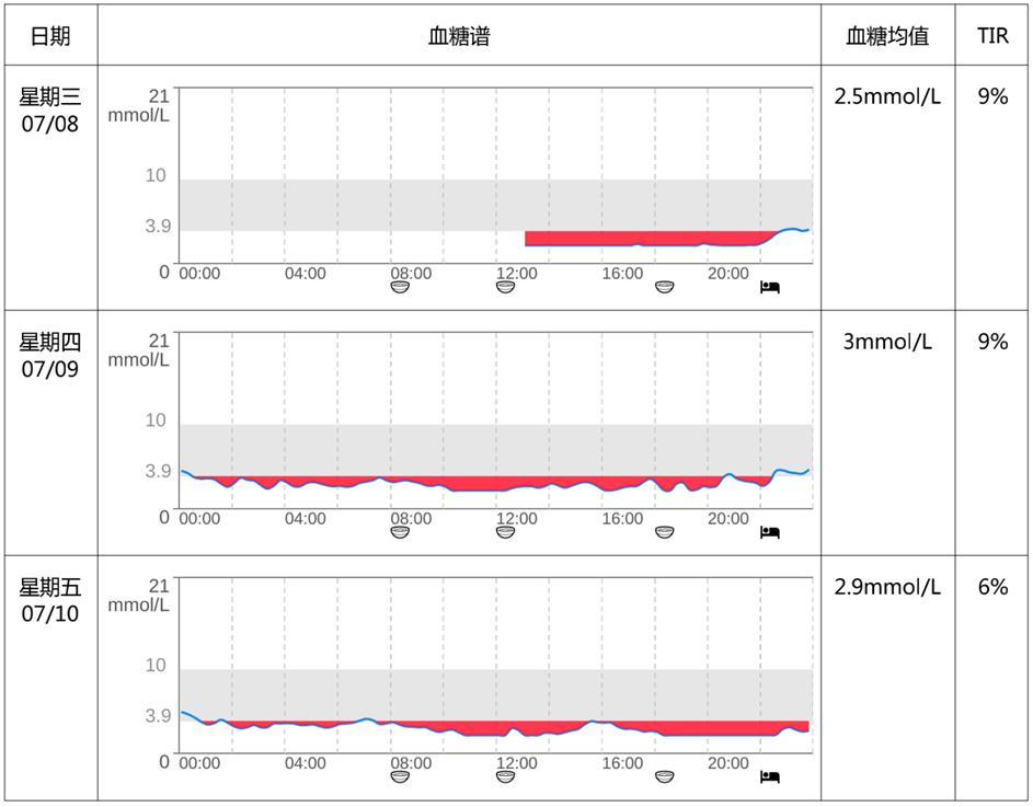反复低血糖是肿瘤吗,读报反复低血糖警惕胰岛素瘤