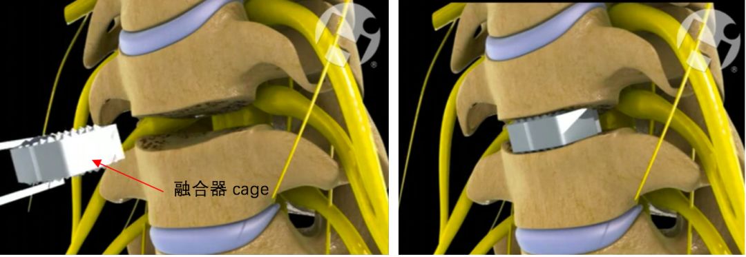 颈椎病是保守治疗还是手术治疗好,颈椎病做什么手术比较安全