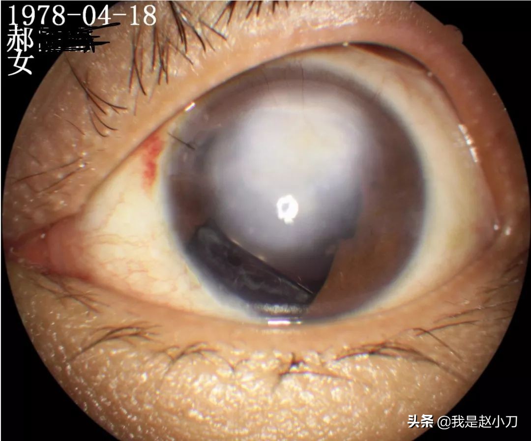 白内障专家赵小刀,白内障赵小刀