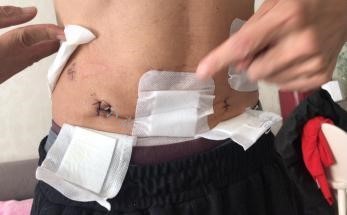 胃痛反酸打嗝后背痛是胃癌吗,29岁小伙胃疼查出胃癌晚期