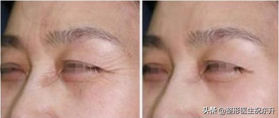 脸颊凹陷玻尿酸填充能保持多久,玻尿酸填充多少次才能保持久一点