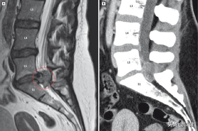 坐骨神经疼痛吃药不见轻,坐骨神经痛中医也治不好吗