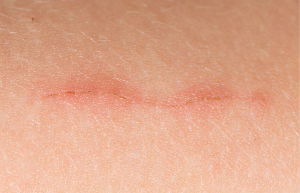 疤痕的最好处理方法,疤痕在什么时候治理最好