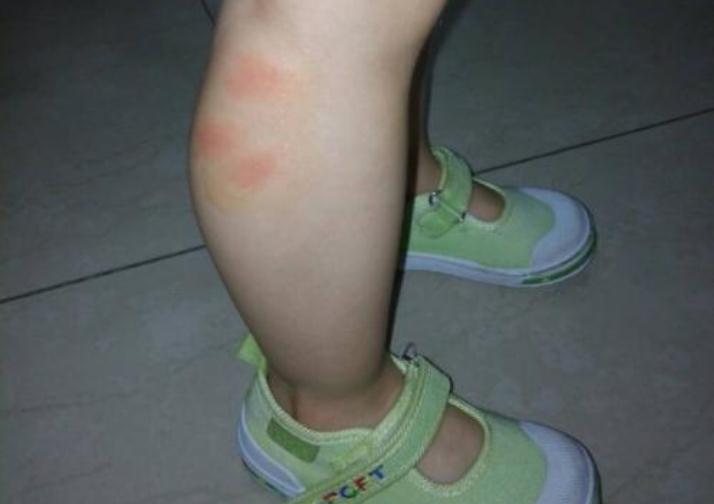 孕妇被蚊子叮了对胎儿有影响吗,孕妇有蚊子用什么防蚊比较好