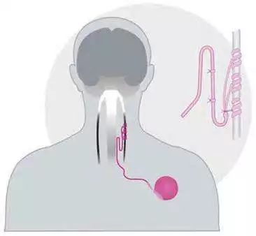 神经元修复治疗癫痫最近进展,癫痫治疗新方法神经调控治疗