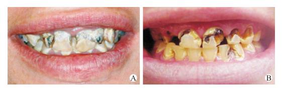 为什么吸毒的人掉牙齿,吸毒的人为什么会烂牙齿