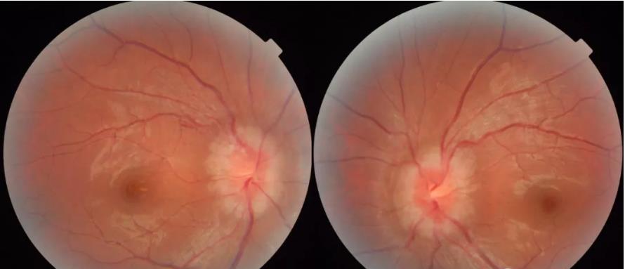 颅高压第一篇:视乳头水肿