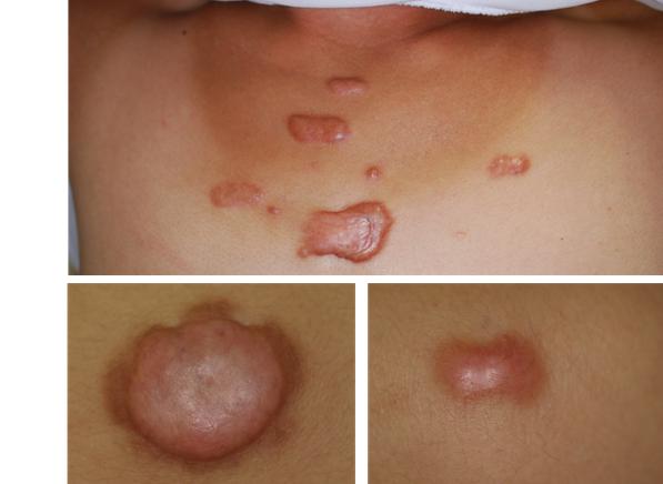 关于疤痕疙瘩，你知道多少？