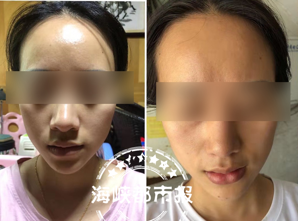 一女子在整容医院整容失败,杭州一女子耳软骨隆鼻花8万元