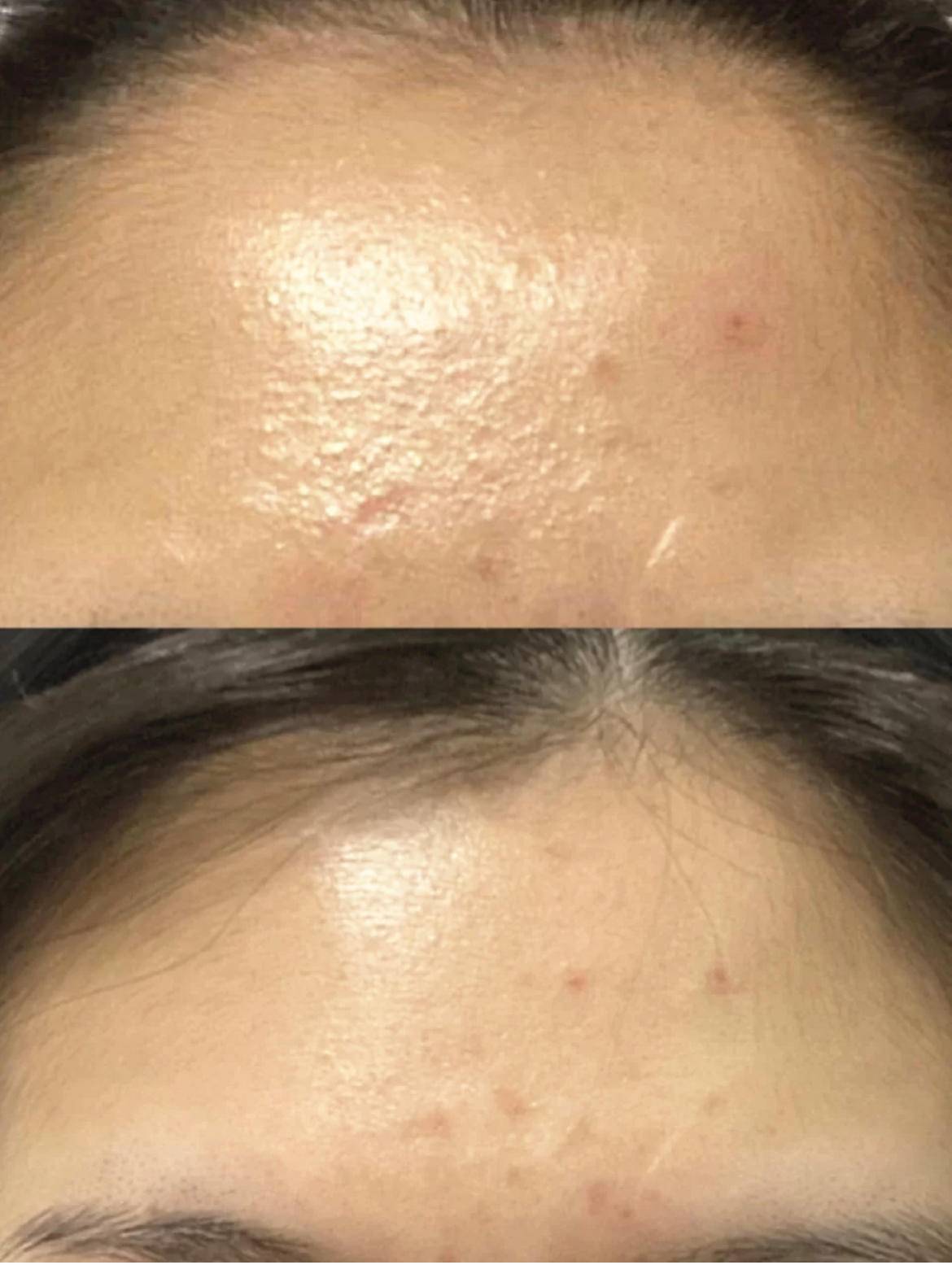 去闭口快速有效的方法,去闭口最有效的方法推荐