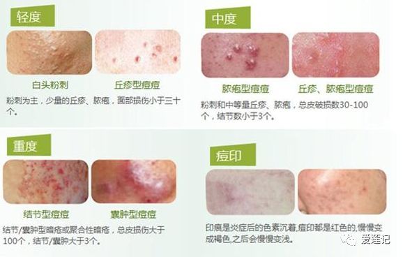 修复痘疤的药,修复痘疤痘坑用什么产品好