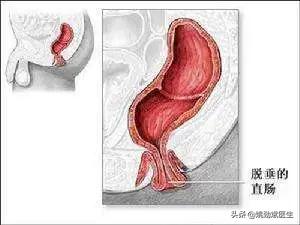 哪些疾病可使得肛门脱出呢？