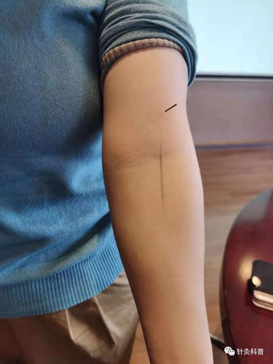 针灸治疗常见疾病方法,伤寒杂病论和针灸