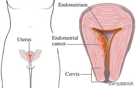 子宫内膜癌术前注意事项,年轻女的容易得的癌