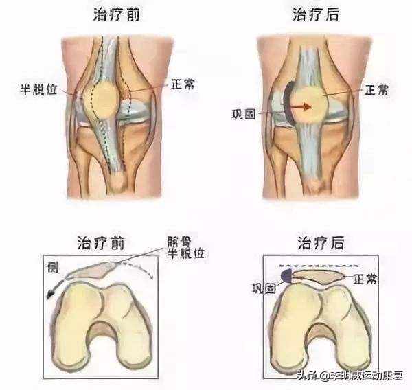 拍片怎样看出髌骨骨折好了,髌骨软化中期应该用什么方法治疗