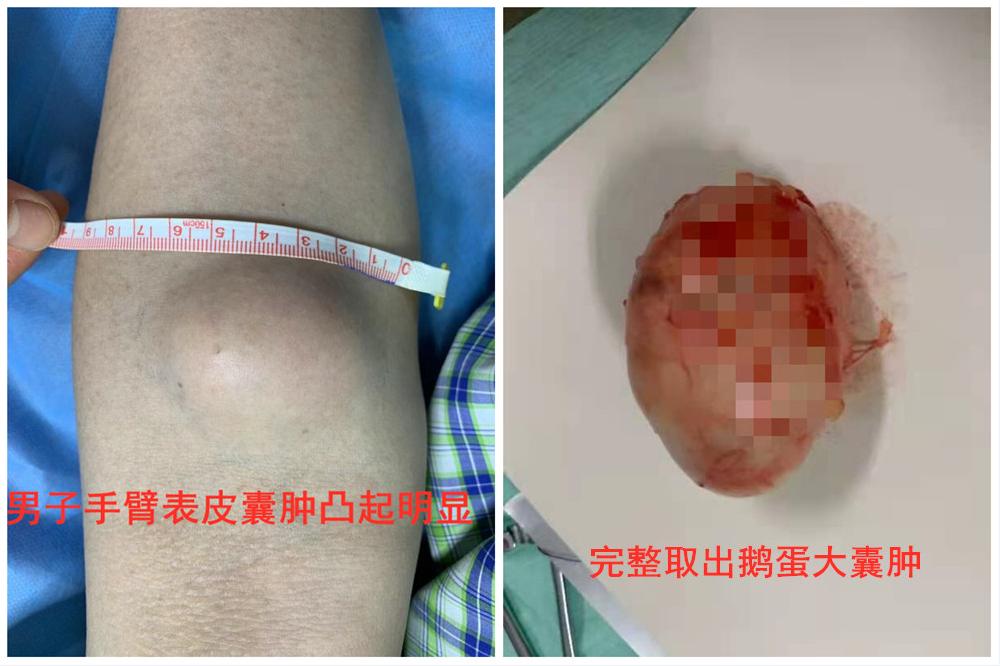 背后长期长了一个鹅蛋大肿块,小手臂长了个凸起的囊肿