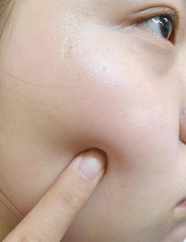 眼睛鳞状上皮增生伴过度角化,眼睛下面的小颗粒是毛周角化吗