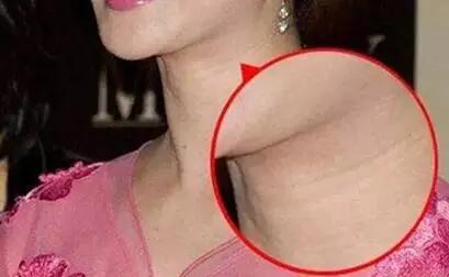 如何避免长大有颈纹,学生淡化颈纹的最佳方法