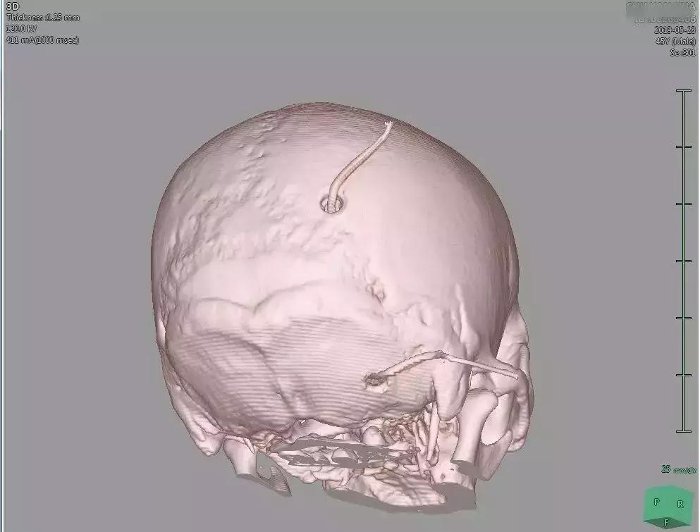 脑干出血五毫升还有救吗,脑干出血5ml危险期