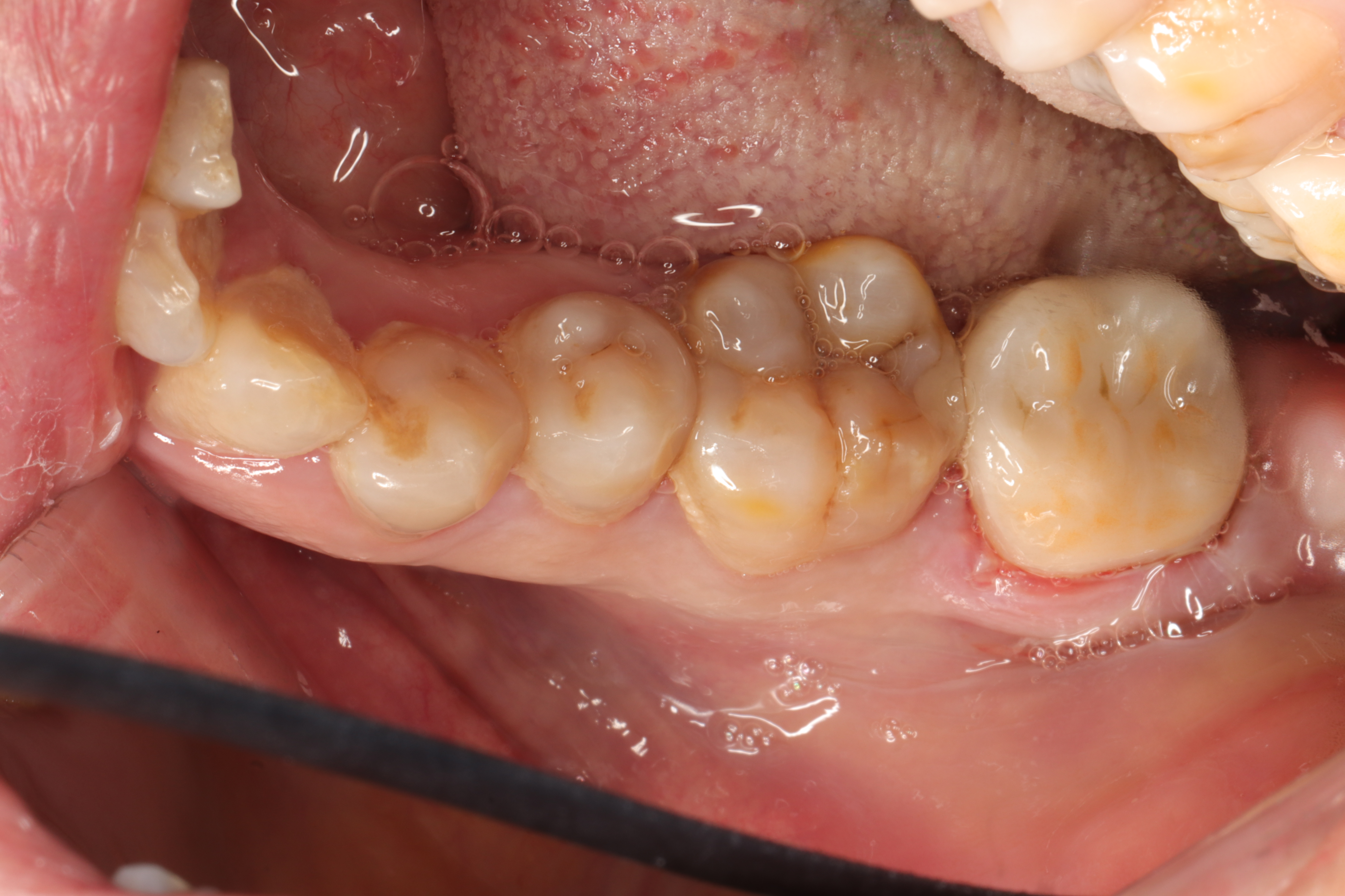 补牙补次数多了洞会越来越大吗,补牙补几次能补完