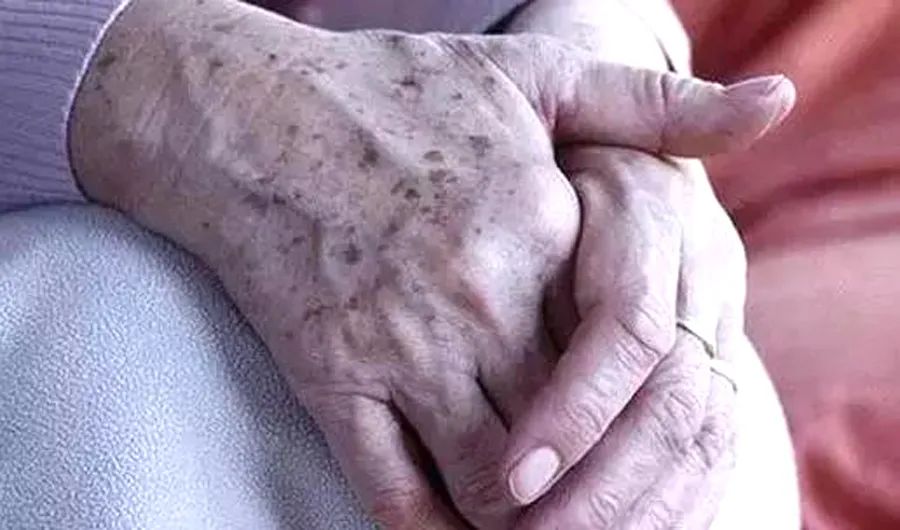 老年人皮肤癌图样,老年斑反复结痂脱落是不是皮肤癌