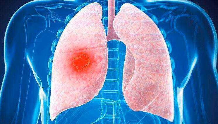 结核病人的脸色什么颜色,结核病人脸色好看吗