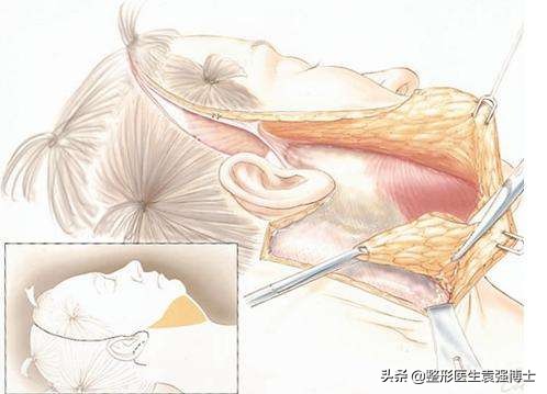 额头拉皮手术能维持几年,耳部小拉皮手术能维持几年