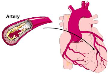 肌钙蛋白升高一定是心梗吗,超敏肌钙蛋白71是心梗还是心肌炎