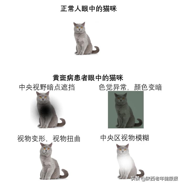 眼睛看不到东西医生说是黄斑病变,最近眼睛里长了黄斑