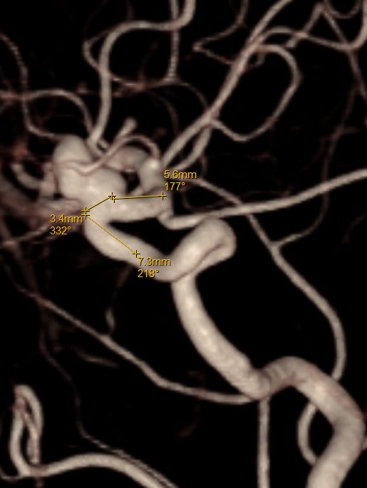 Tubridge®治疗多发性动脉瘤