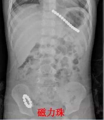 4岁男孩吞2cm钉子,4岁男孩吞下一颗5厘米钢钉