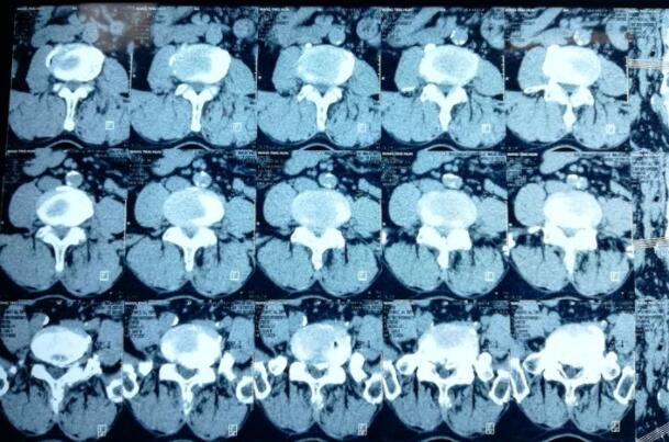 椎间盘斑点状钙化影,颈椎间盘钙化严重吗